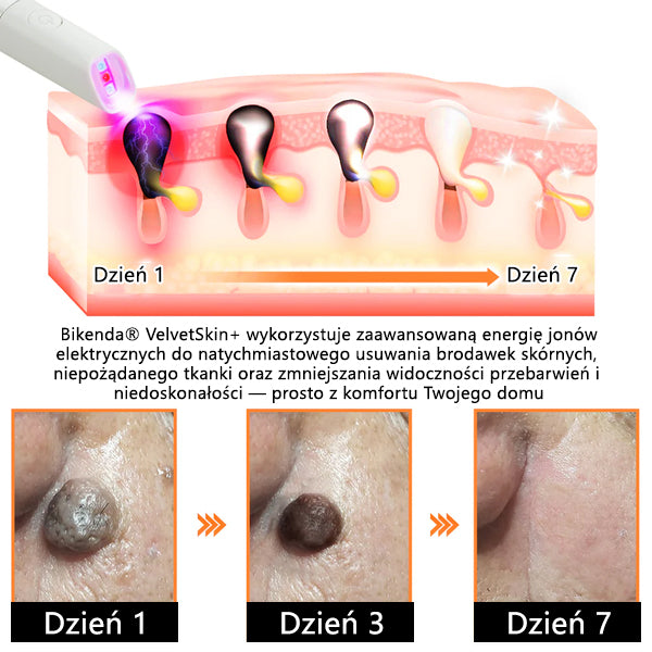 ✨ Bikenda®  – Laserowy Długopis CO₂ do Usuwania 🟤 Znamion, 🦠 Brodawek, 🔘 Przebarwień i Innych Niedoskonałości Skóry