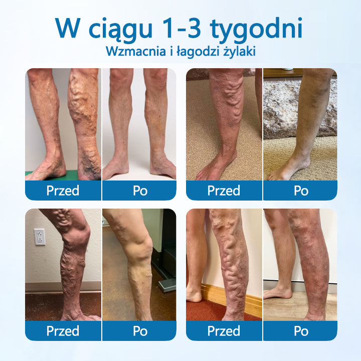 🌿🌿 🌿Timilk® – Ziołowy Spray na Żylaki z Potwierdzoną Skutecznością w 7 Dni!
