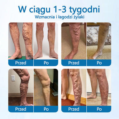 🌿🌿 🌿Timilk® – Ziołowy Spray na Żylaki z Potwierdzoną Skutecznością w 7 Dni!