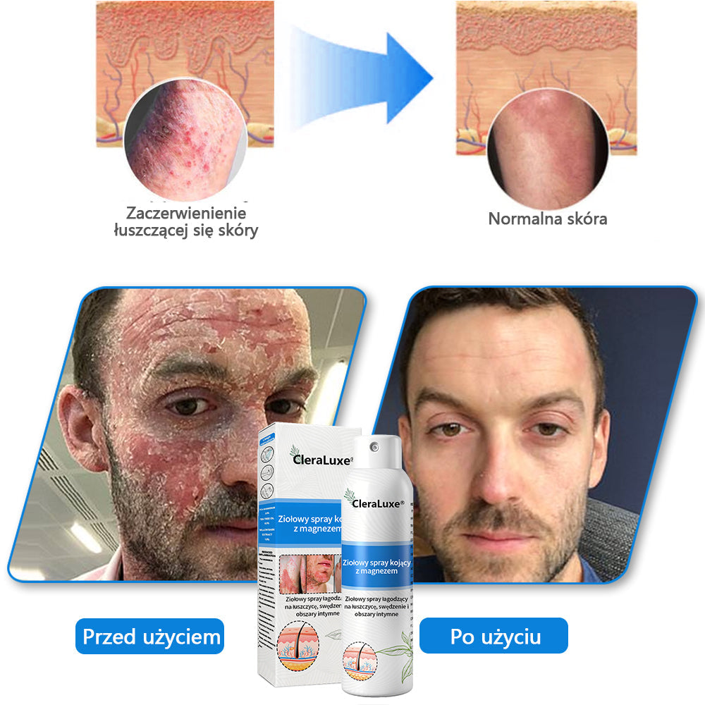 Oficjalny sklep✅: CleraLuxe®Magnezowy spray ziołowy na łuszczycę📦