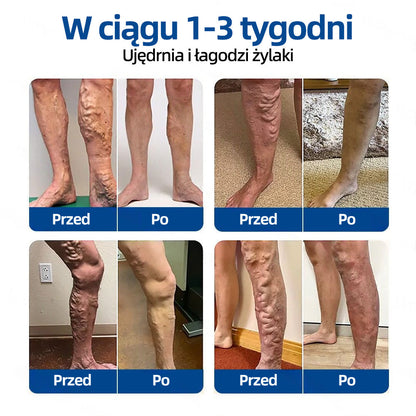 🇵🇱 Healrize® VeinTarget Plaster z mikroigłami |⚡ Natychmiastowa ulga, długotrwałe efekty