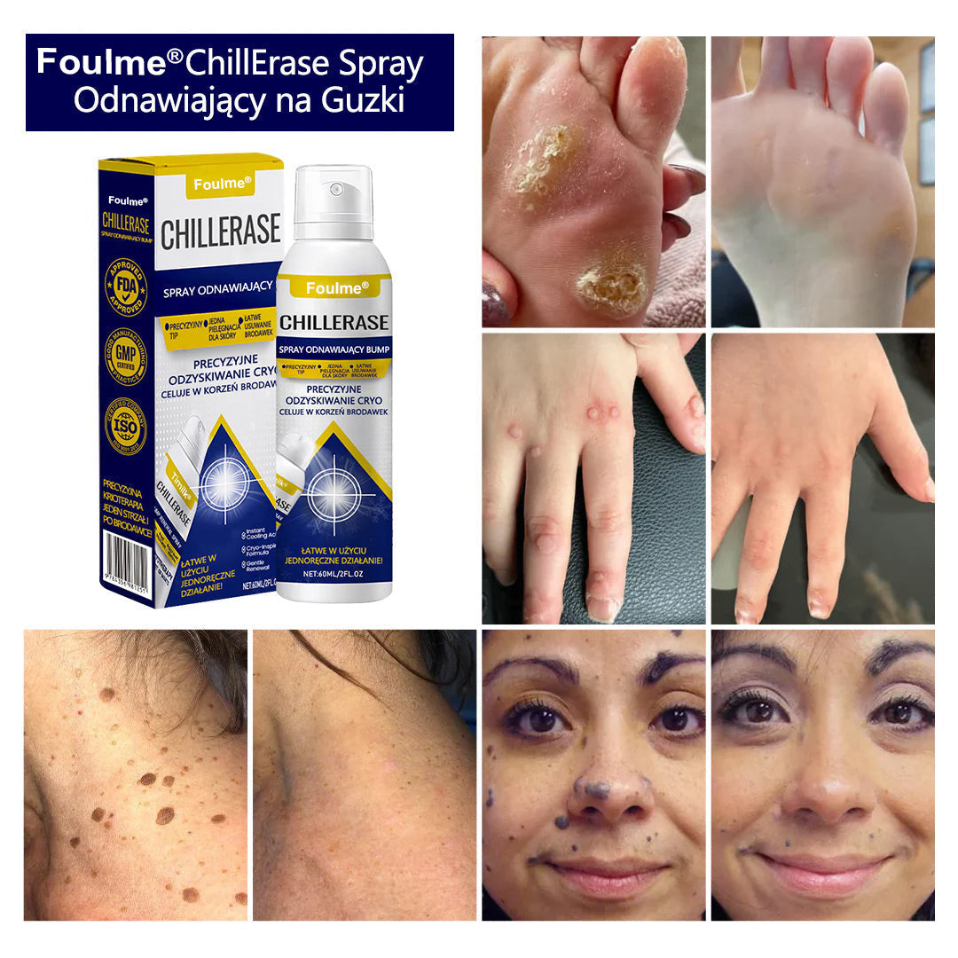 🔥Foulme® ChillErase Spray odnawiający skórę❄️