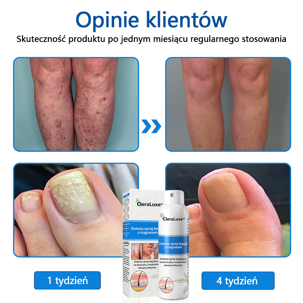 Oficjalny sklep✅: CleraLuxe®Magnezowy spray ziołowy na łuszczycę📦