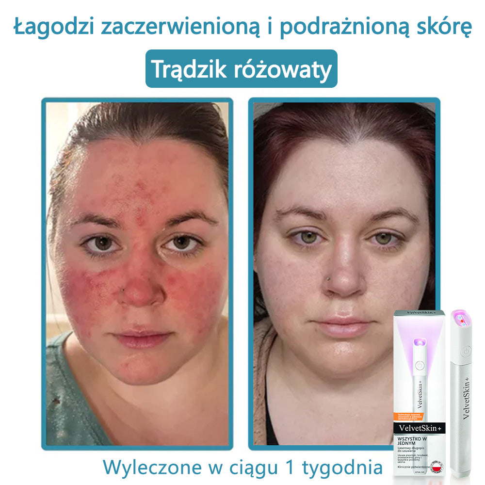 ✨ Bikenda®  – Laserowy Długopis CO₂ do Usuwania 🟤 Znamion, 🦠 Brodawek, 🔘 Przebarwień i Innych Niedoskonałości Skóry
